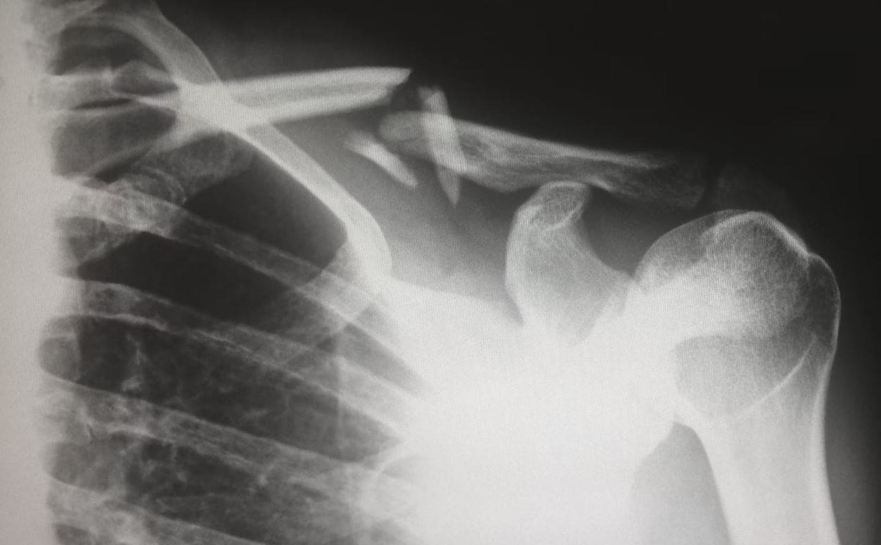 Medical Malpractice Lawyer in Israel - X-ray of a shattered collarbone
